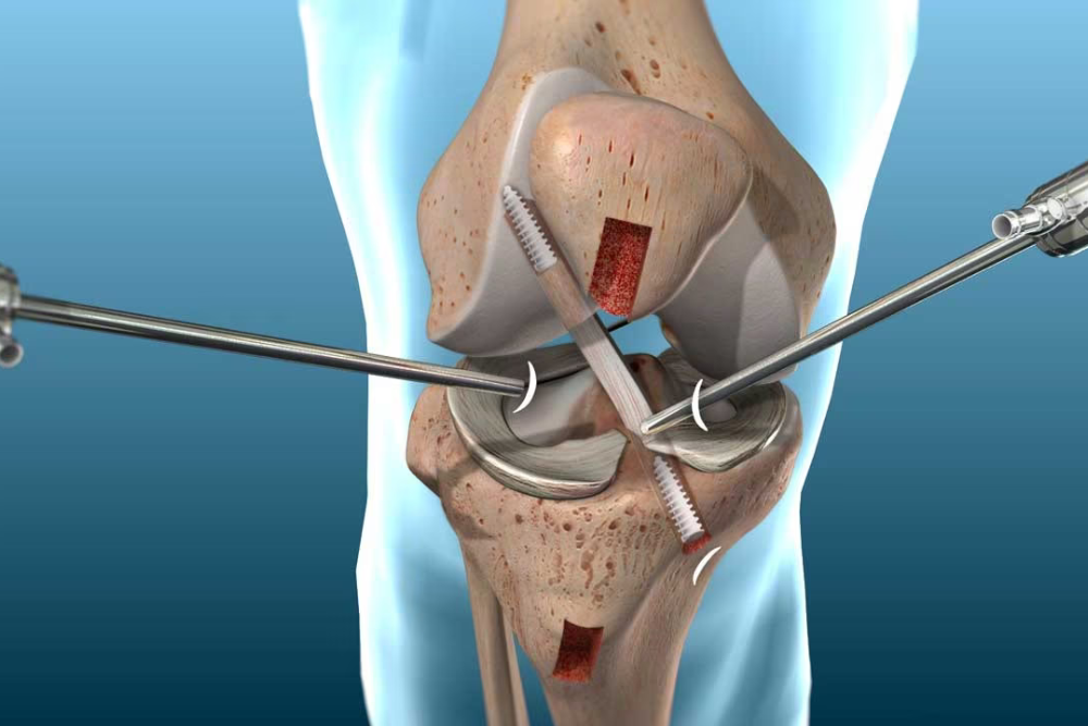 ACL Reconstruction