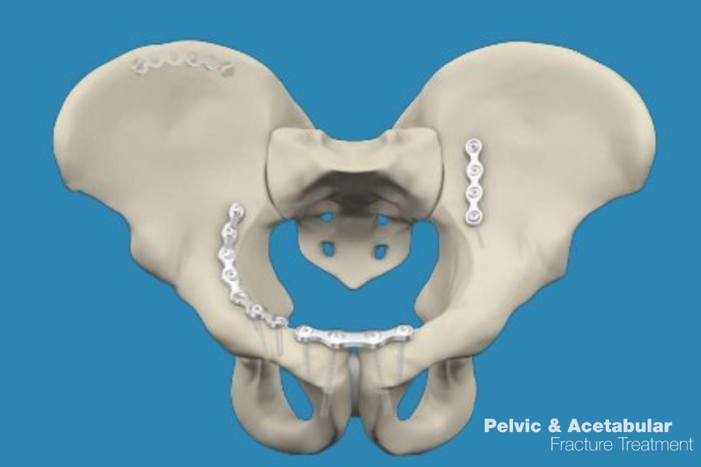 Pelviacetabular Fracture Complications