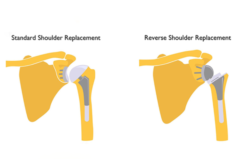 Reverse Shoulder Replacement